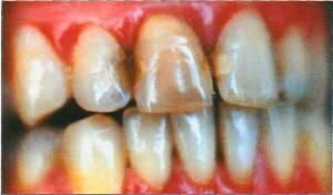 Аномалии цвета зубов